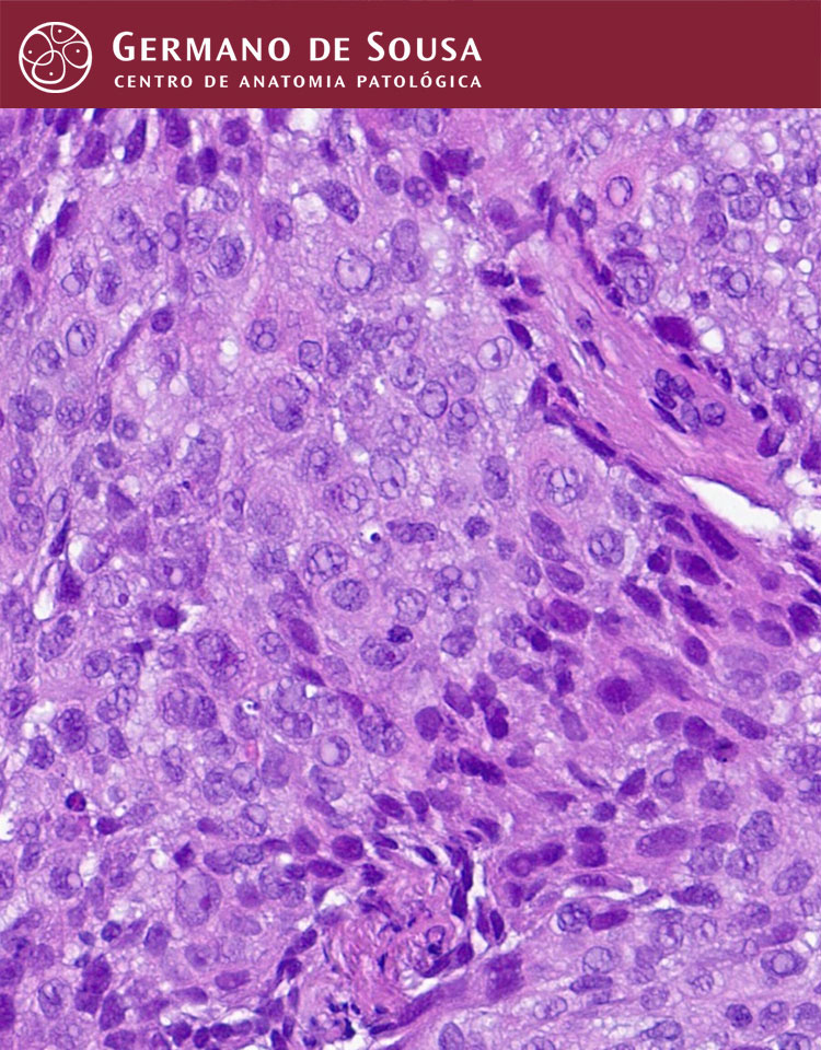 Patologia Pulmonar