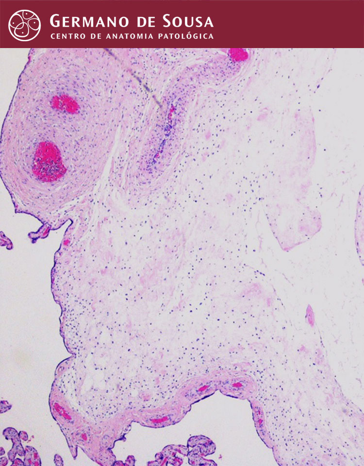 Patologia Fetal