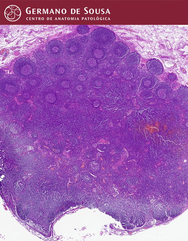 Patologia Hematolinfoide