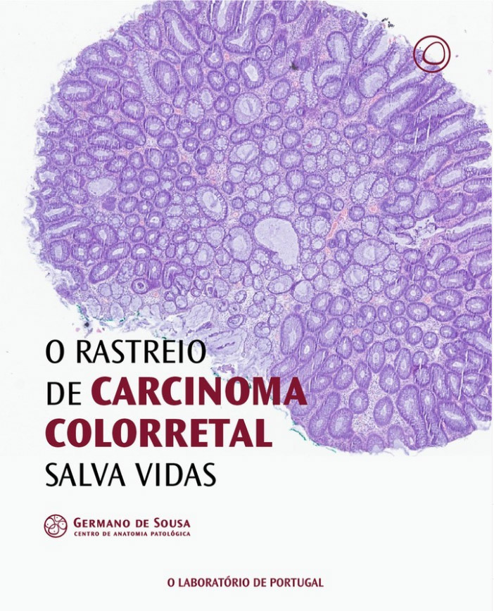 Rastreio de carcinoma colorretal salva vidas