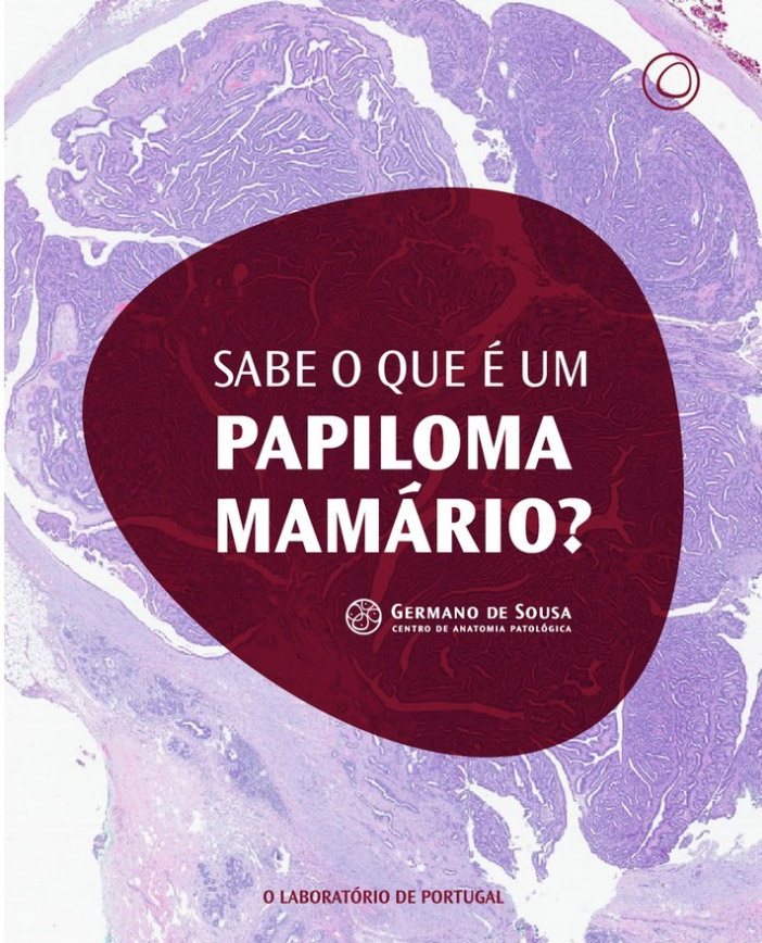 Sabe o que é um papiloma mamário